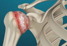 Viscosupplementation for Shoulder Arthritis