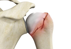 Complex Fracture Repair of the Shoulder