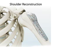 Shoulder Reconstruction Surgery