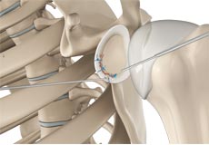 Arthroscopic Bankart Repair