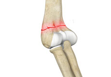 Distal Humerus Fractures of the Elbow