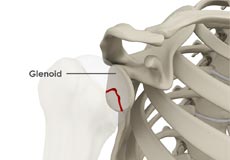 Glenoid Fractures