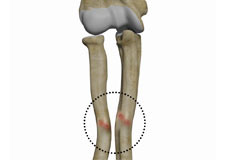 Malunion Surgery (Elbow)