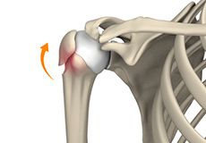 Malunion Surgery of the Shoulder