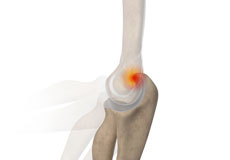 Posterior Impingement of the Elbow