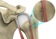 Proximal Biceps Tendon Rupture