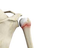 Proximal Humerus Fractures