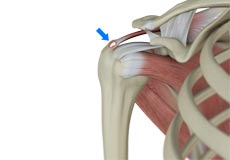 Rotator Cuff Calcification