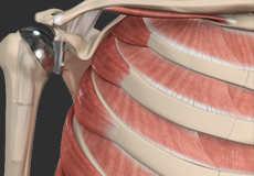 Computer Navigation for Shoulder Replacement