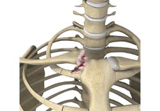 Sternoclavicular Joint Reconstruction