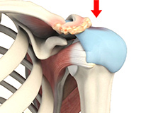 Arthroscopic Subacromial Decompression Surgery